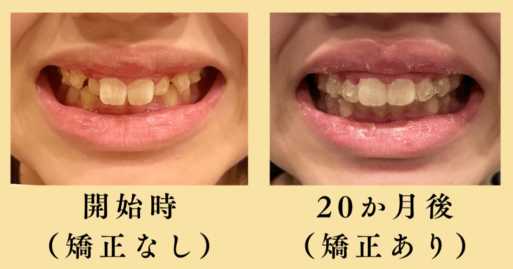 治療開始時と20か月後の歯並び