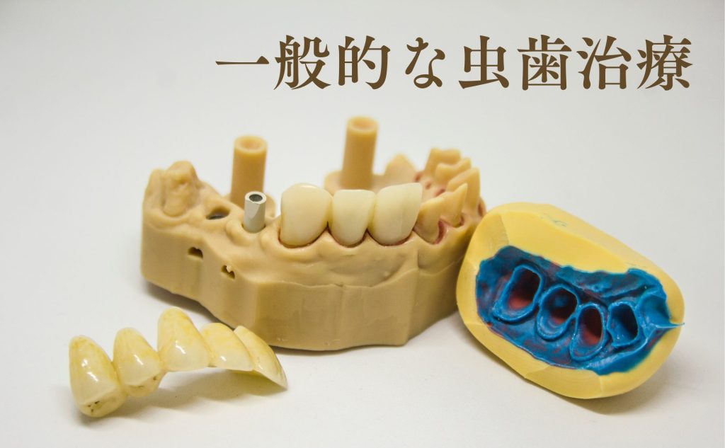 一般的な虫歯治療の文字と歯科模型の写真
